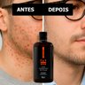 antes e depois foliculite jovem